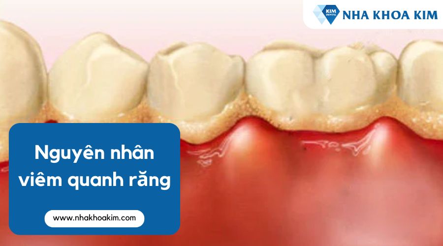 Nguyên nhân gây viêm quanh răng