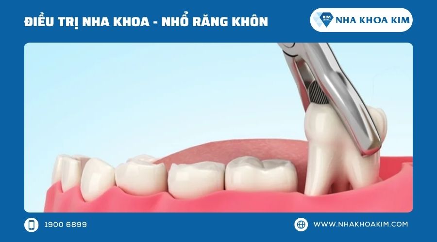 Nhổ răng khôn hàm trên