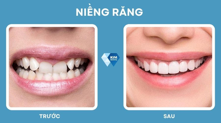 Niềng răng để có nụ cười đều và đẹp hơn