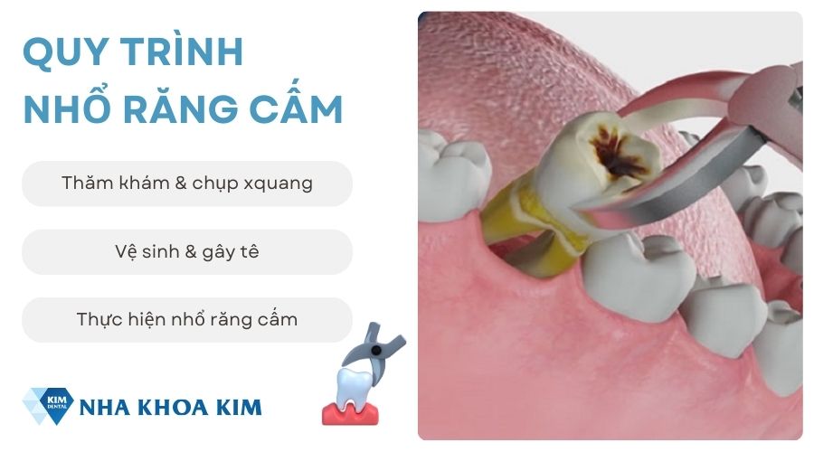 Quy trình nhổ răng cấm tại Nha Khoa Kim