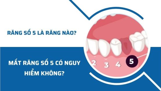 Răng số 5 là răng nào? Mất răng số 5 có nguy hiểm không?