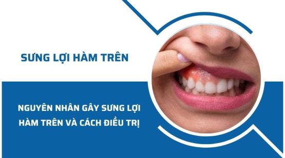 Nguyên nhân gây sưng lợi hàm trên và cách điều trị