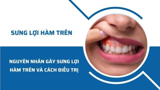 Nguyên nhân gây sưng lợi hàm trên và cách điều trị