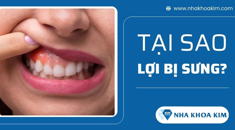 Tại sao lợi bị sưng?