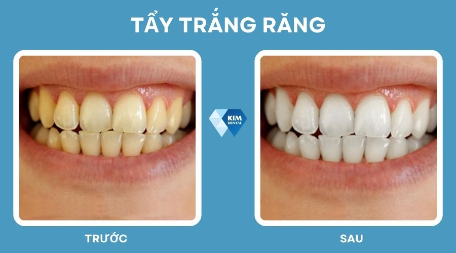 Tẩy trắng răng để có nụ cười đẹp và trắng sáng hơn