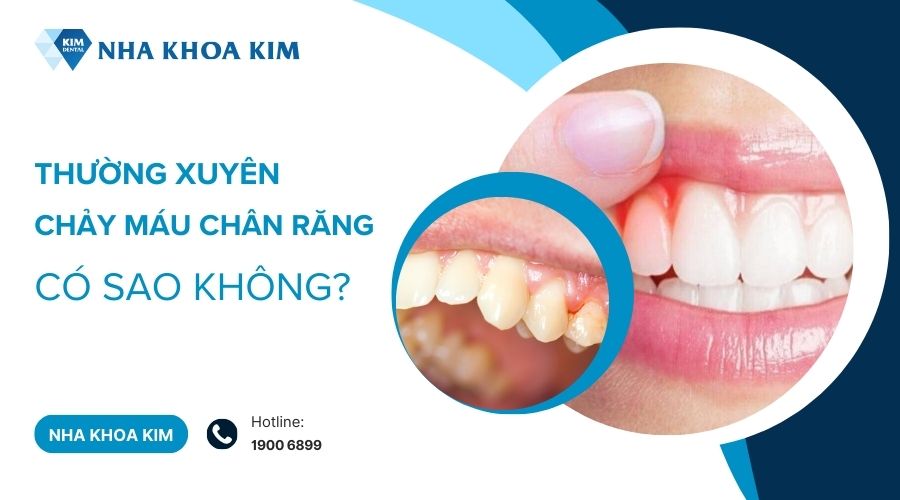 Thường xuyên bị chảy máu chân răng có sao không?