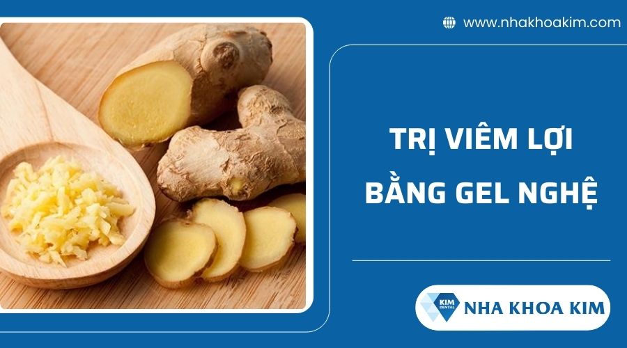 Cách chữa viêm lợi tại nhà bằng gel nghệ