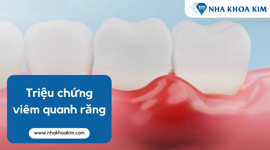 Triệu chứng của viêm quanh răng