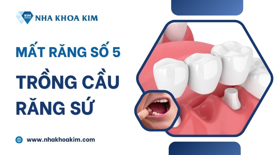 Khôi phục răng số 5 bị mất bằng cầu răng sứ