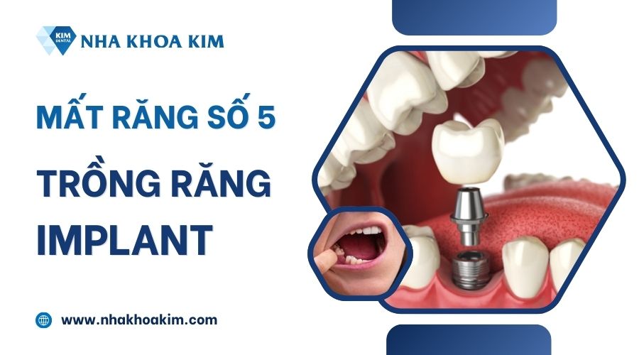 Trồng implant thay răng số 5 bị mất