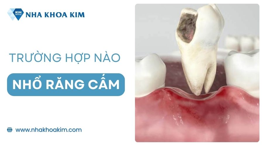 Trường hợp nào nên và không nên nhổ răng cấm?