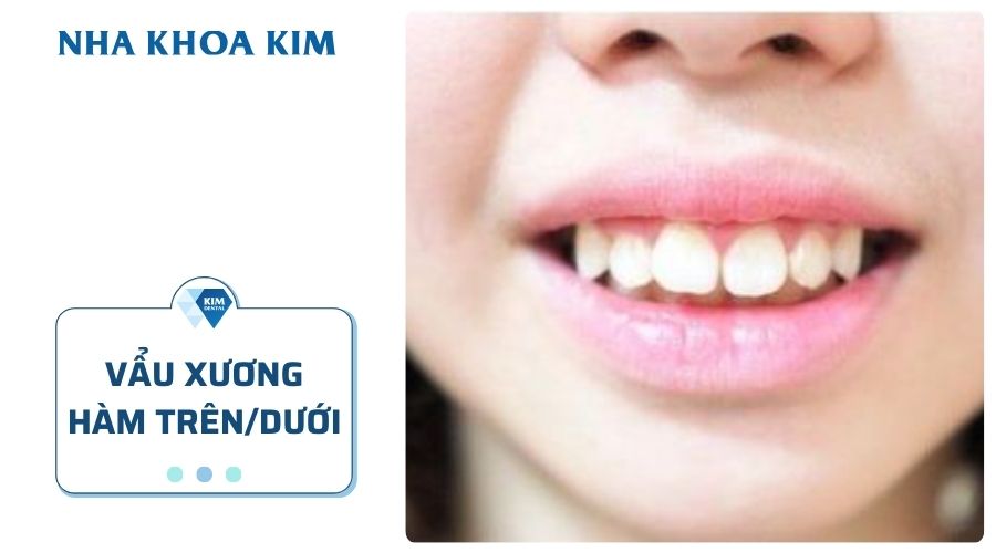 Vẩu (hô) xương hàm dưới/trên