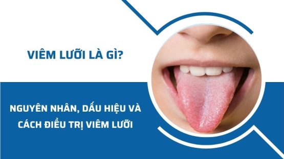 Viêm lưỡi là gì? Nguyên nhân, dấu hiệu và cách điều trị