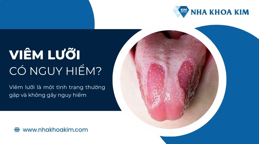 Viêm lưỡi có nguy hiểm không?