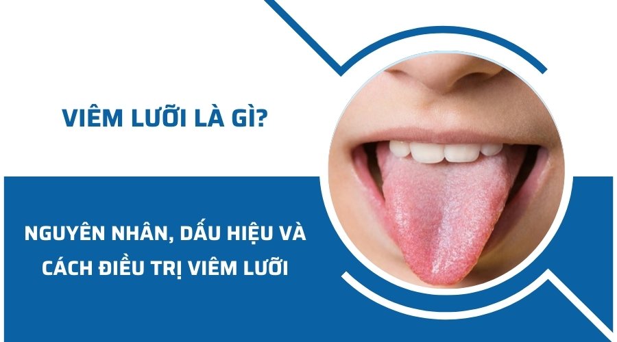 Viêm lưỡi là gì? Nguyên nhân, dấu hiệu và cách điều trị