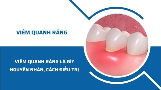 Viêm quanh răng là gì? Nguyên nhân và cách điều trị