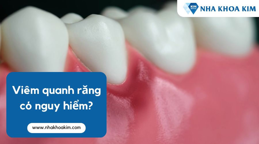 Viêm quanh răng có nguy hiểm không?