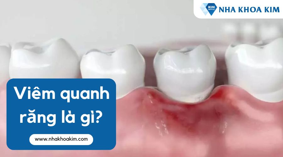 Viêm quanh răng là gì?