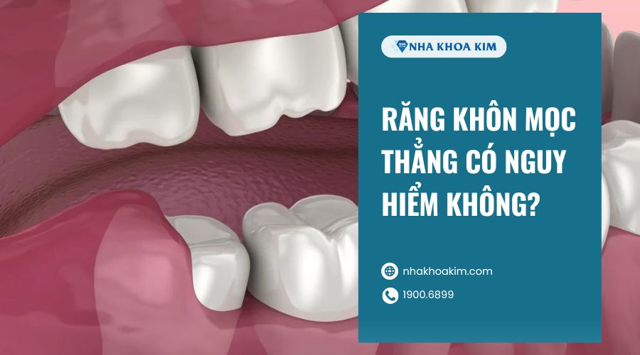 Răng khôn mọc thẳng có nguy hiểm không