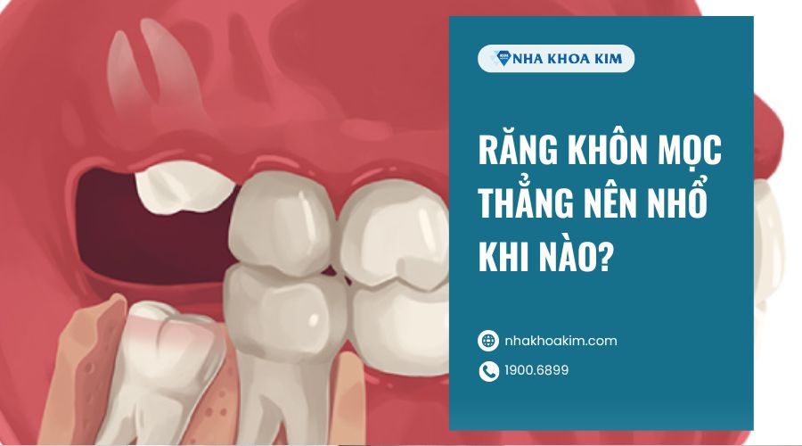 Răng khôn mọc thẳng nên nhổ khi nào
