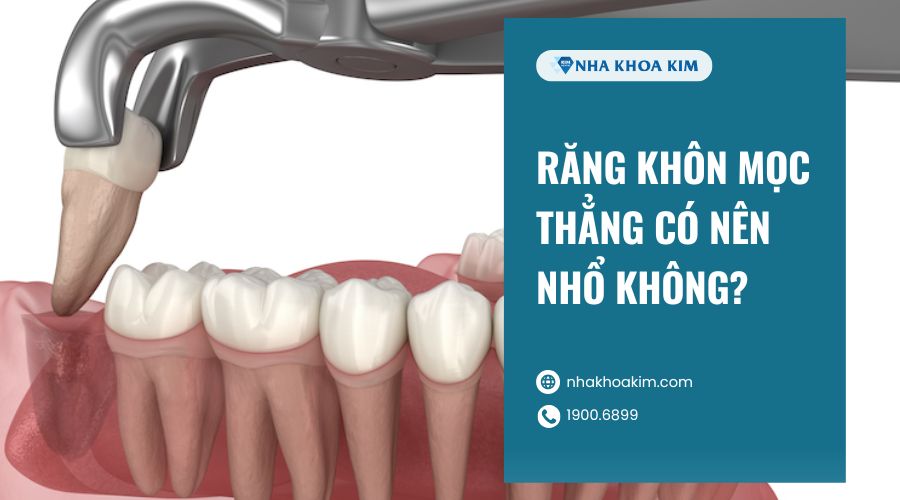 Răng khôn mọc thẳng thì có nên nhổ không