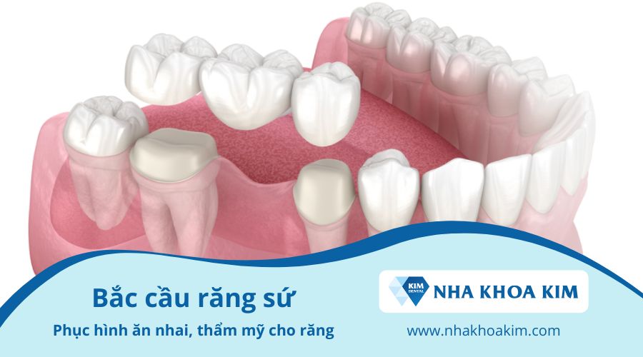 Khắc phục tình trạng rụng răng bằng cầu răng sứ