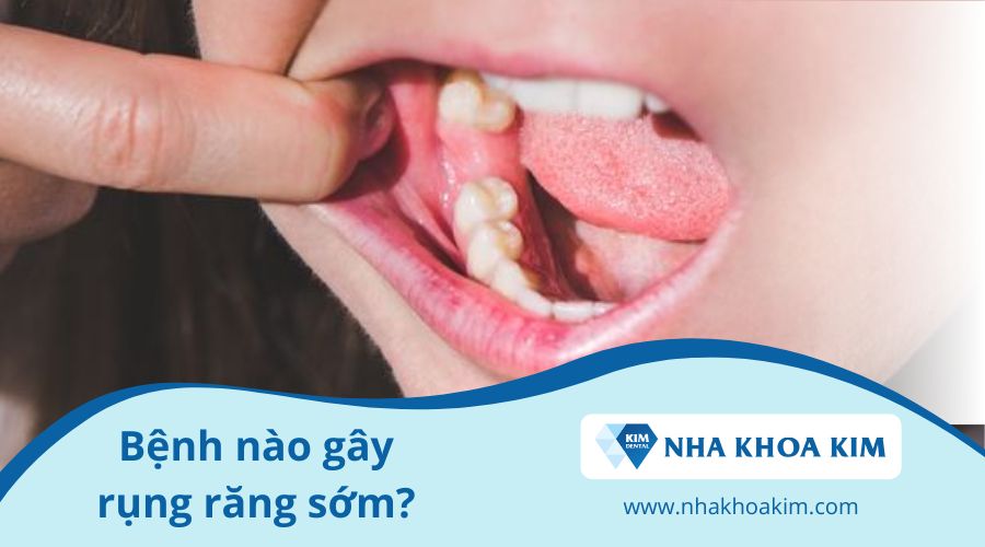 Bệnh nào dễ gây rụng răng sớm