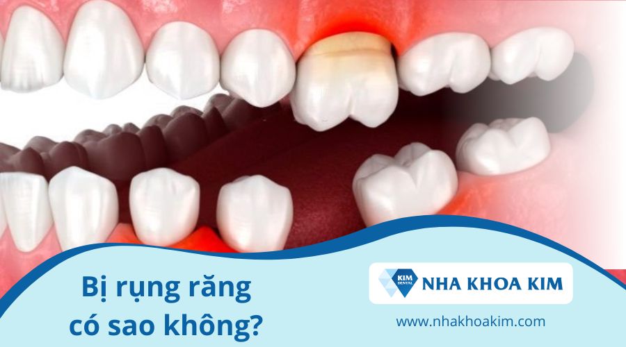 Bị rụng răng có sao không?