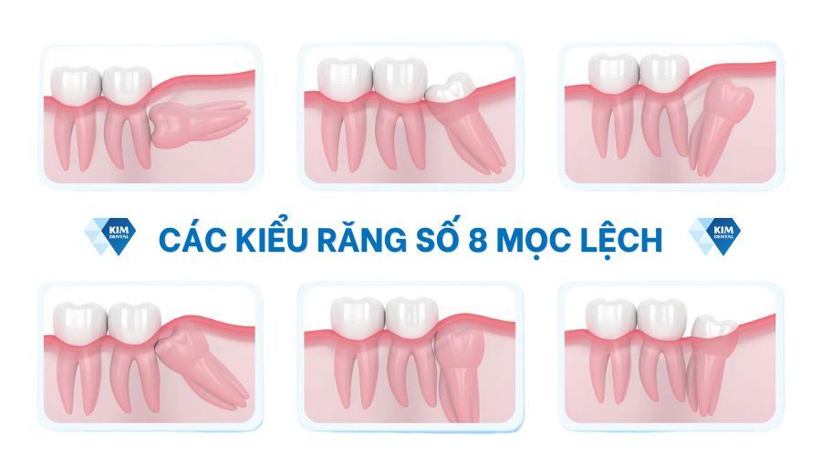 Các kiểu mọc lệch của răng số 8