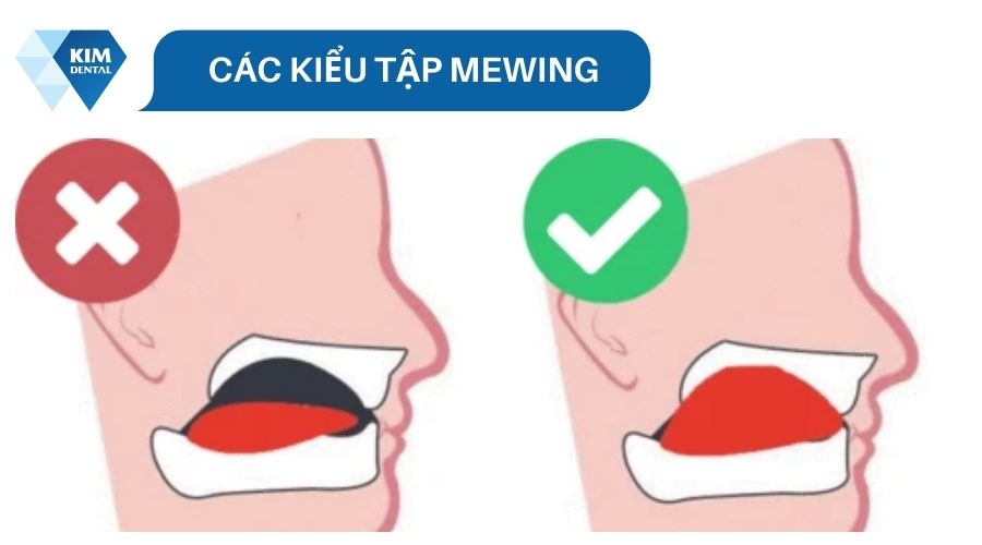 Các kiểu tập Mewing