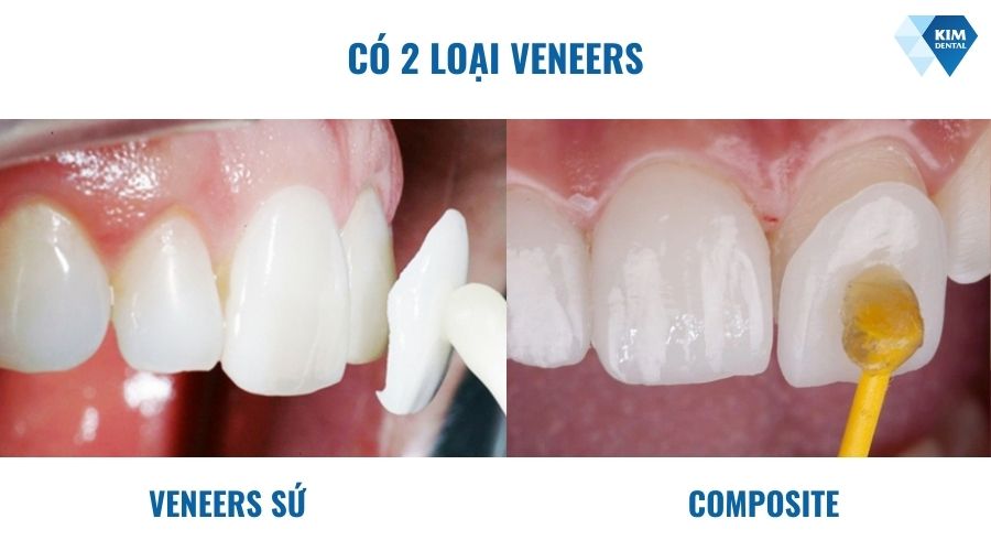 Các loại veneers