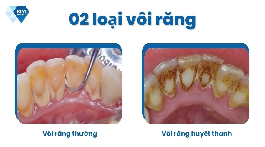 Các loại vôi răng