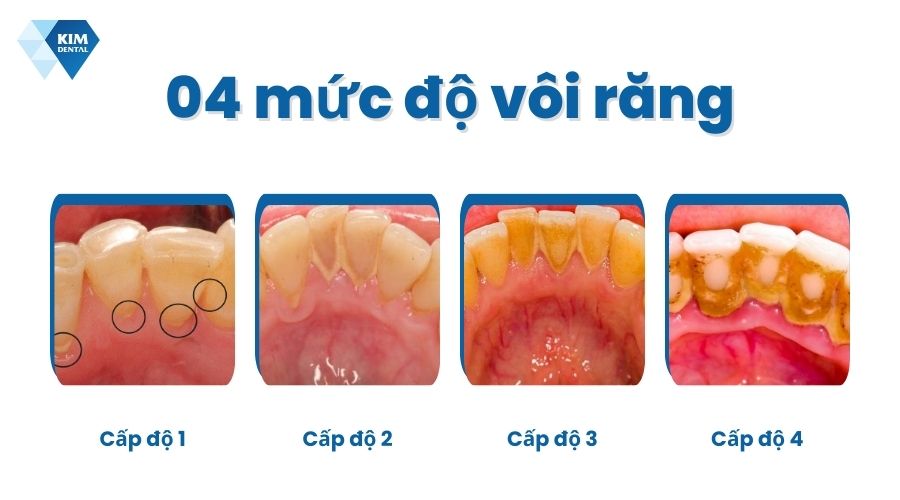 Các mức độ vôi răng
