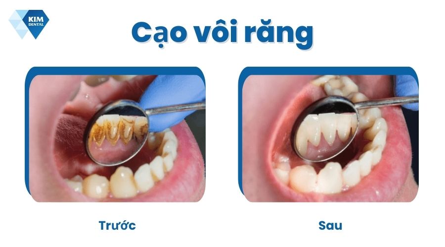 Cách điều trị vôi răng
