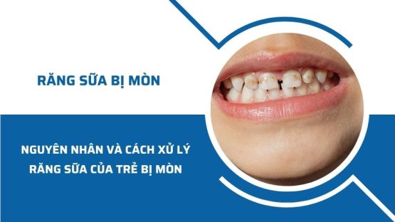 Nguyên nhân và cách xử lý khi răng sữa của trẻ bị mòn