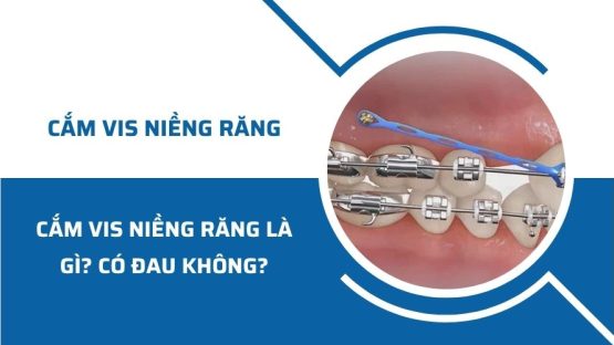 Cắm vis niềng răng là gì? Có đau không?