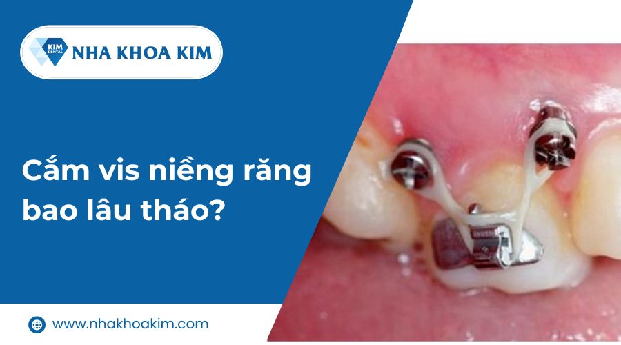 Cắm vít niềng răng bao lâu tháo?