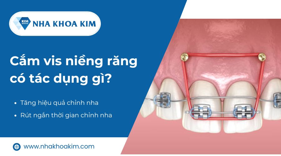 Cắm vis niềng răng có tác dụng gì?