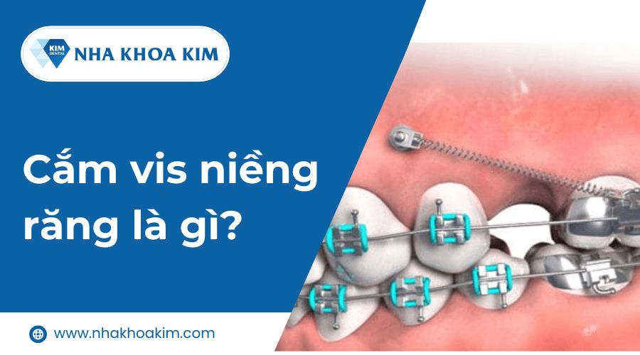 Cắm vis niềng răng là gì?