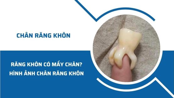 Răng khôn có mấy chân? Hình ảnh chân răng khôn