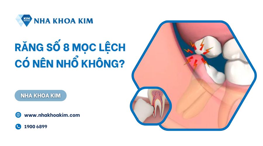 Răng số 8 mọc lệch có nên nhổ?