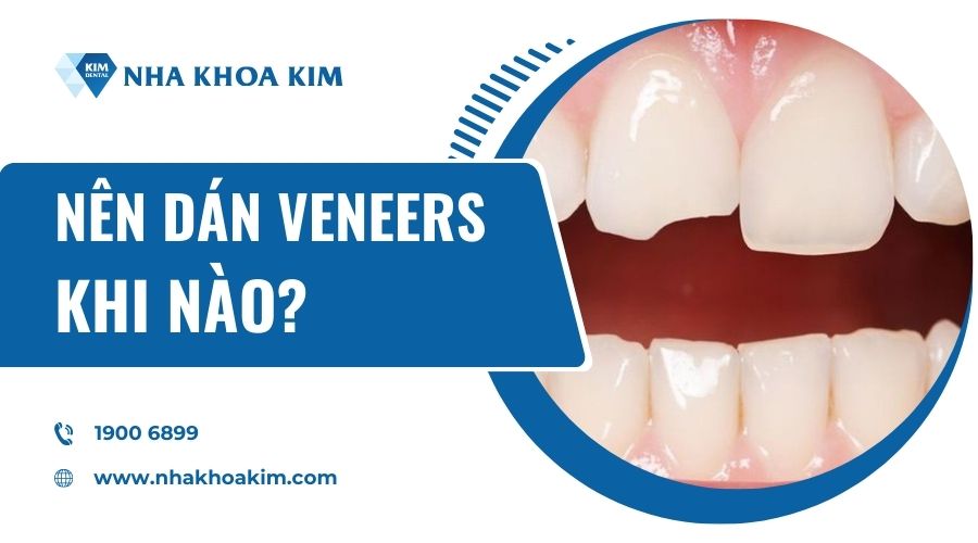 Nên dán veneers khi nào?