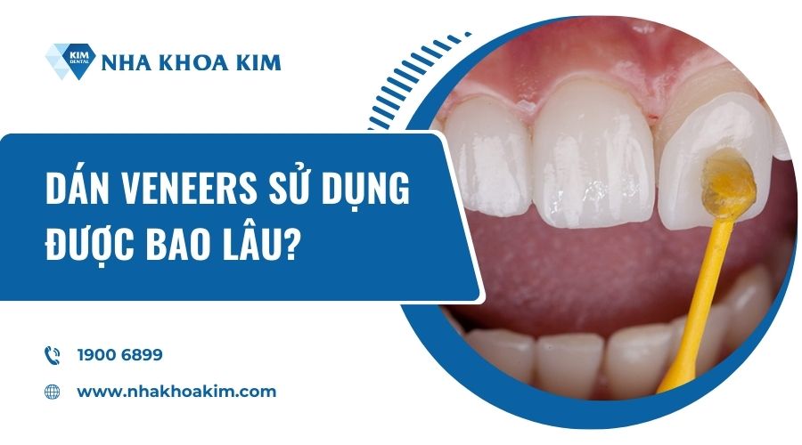 Dán sứ veneers có bền không?