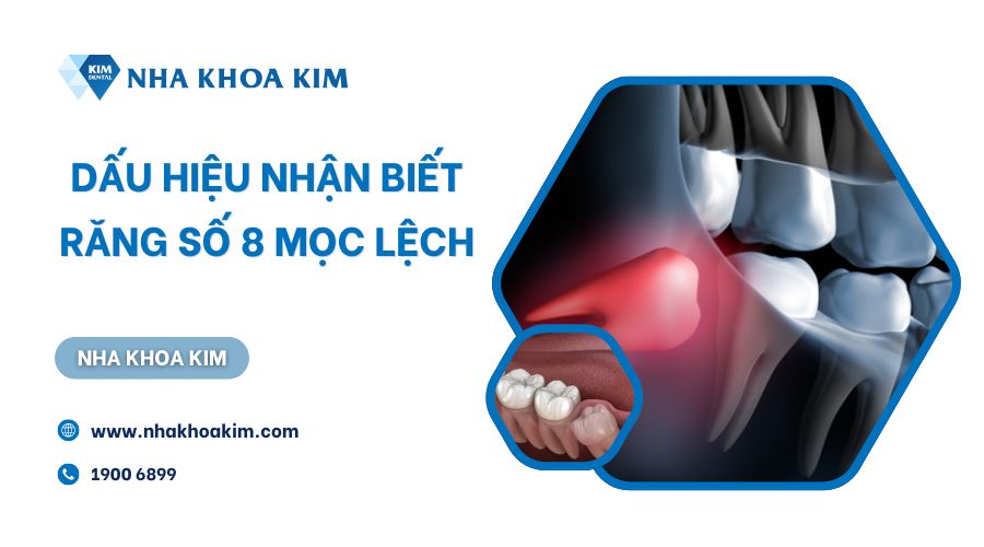 Dấu hiệu nhận biết răng số 8 mọc lệch
