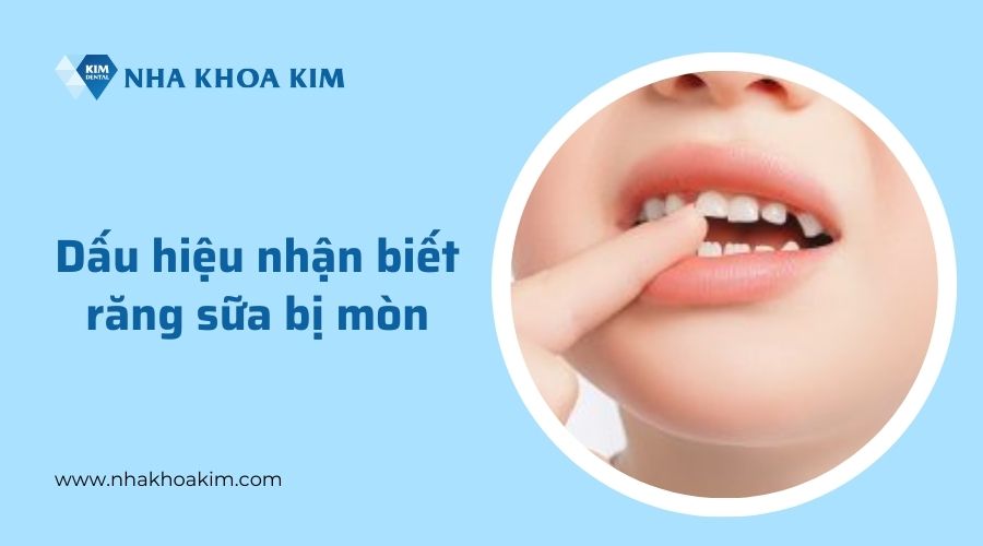 Dấu hiệu răng sữa bị ăn mòn