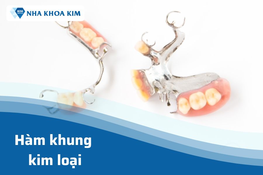 Hàm khung liên kết kim loại