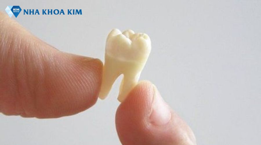 Hình ảnh răng khôn có 2 chân