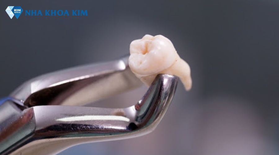 Hình ảnh chân răng khôn móc câu