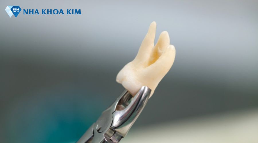 Hình ảnh chân răng khôn bị cong