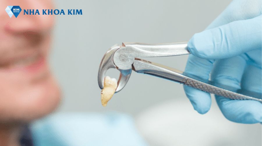 Hình ảnh chân răng khôn mọc lệch